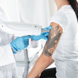 tratamiento-eliminacion-tatuaje-dermotrain(1920x1280)