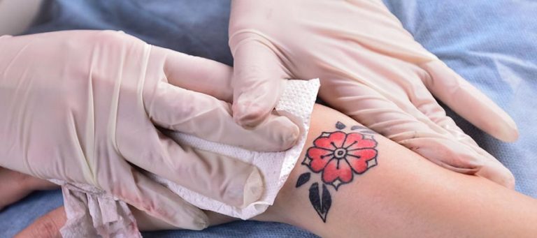 Lee más sobre el artículo Aparatos para borrar tatuajes